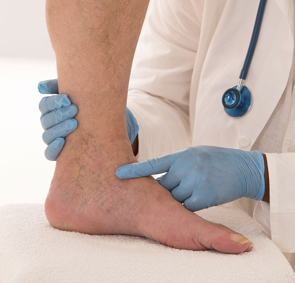 Blood Clots On Foot Top Sellers | emergencydentistry.com